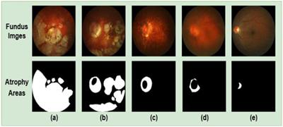 ARA-net: an attention-aware retinal atrophy segmentation network coping with fundus images